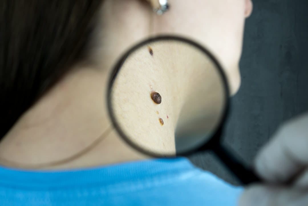 Photodynamic therapy is used in dermatology to treat pre-cancerous and cancerous skin lesions.